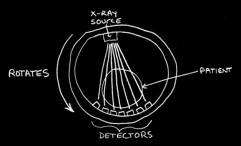 Υπολογιστική Τοµογραφία, CT Η τοµογραφική απεικόνιση επιτυγχάνεται