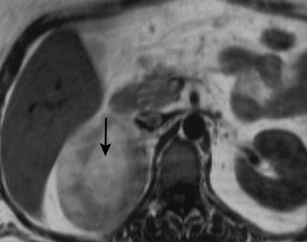 ακολουθία καταπίεσης του λίπους fat suppression (β), εύρημα ενδεικτικό λιπώδους ιστού.