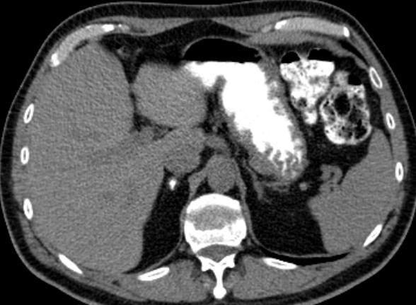 Επασβεστώσεις επινεφριδίων Αξονική τομογραφία χωρίς iv