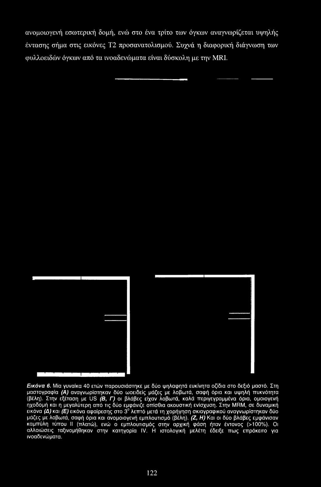 Στην εξέταση με US (Β, Γ) οι βλάβες είχαν λοβωτά, καλά περιγεγραμμένα όρια, ομοιογενή ηχοδομή και η μεγαλύτερη από τις δύο εμφάνιζε οπίσθια ακουστική ενίσχυση.