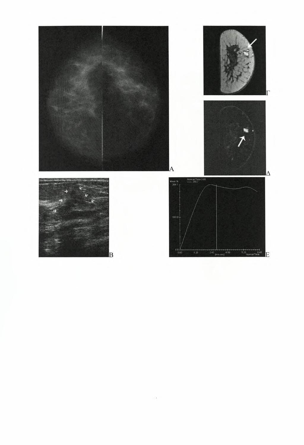 Εικόνα 8. Μία γυναίκα 42 ετών παρουσιάστηκε με ένα ψηλαφητό ογκίδιο στο άνω-έσω τεταρτημόριο του δεξιού μαστού. Στη μαστογραφία (Α) δεν υπήρχαν παθολογικά ευρήματα.