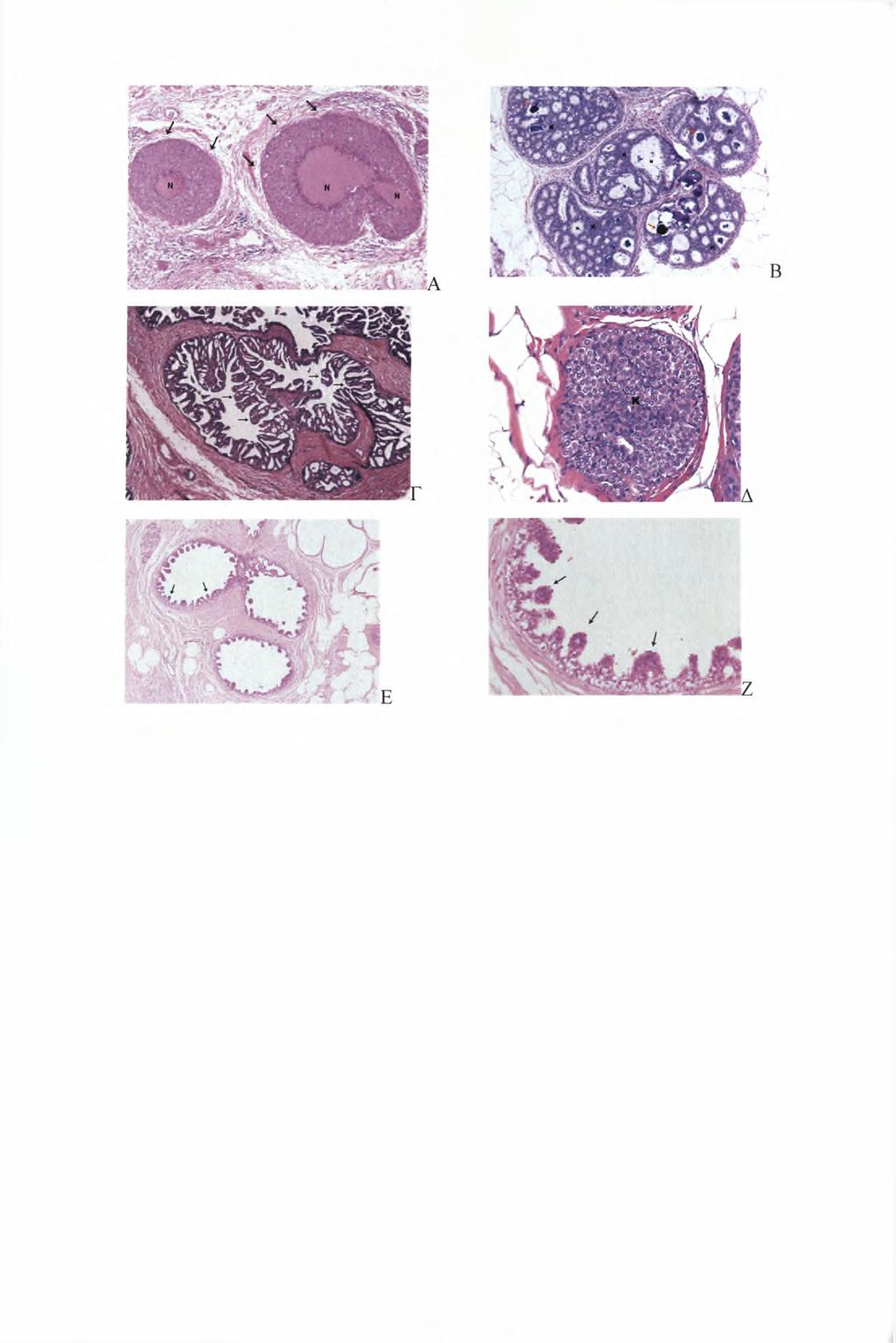 Εικόνα 3-11. DCIS. (Α) Φαγεσωρικό. Τα καρκινικά κύτταρα (βέλη) περιβάλλουν περιοχές νέκρωσης (Ν) (Β) Ηθμοειδές.