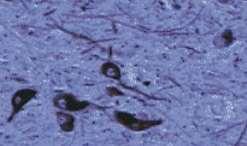 Loss of pigmented dopaminergic neurons Normal