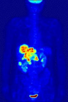 Εσωτερική Ραδιογραφία - ΡΕΤ Το πιο συνηθισμένο ραδιοφάρμακο : 2-[ 18 F]φθορο- 2-δεοξυ-D-γλυκόζη.
