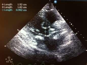 PREDICTORS FOR PPM AFTER TAVI LVOT/annulus