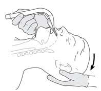 (Εικόνα 3) Τοποθετήστε το κεφάλι και τον αυχένα σε θέση κανονικής τραχειακής διασωλήνωσης.