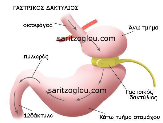 Οι επεμβάσεις που είναι αποδεκτές είναι η λαπαροσκοπική τοποθέτηση γαστρικού δακτυλίου, η λαπαροσκοπική επιμήκης γαστρεκτομή, η γαστρική παράκαμψη και η χολοπαγκρεατική εκτροπή.