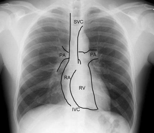 σεµίαορθήα/αθώρακα: ΑΡ καρδιακές δοµές που συµµετέχουν στην ακτινογραφική