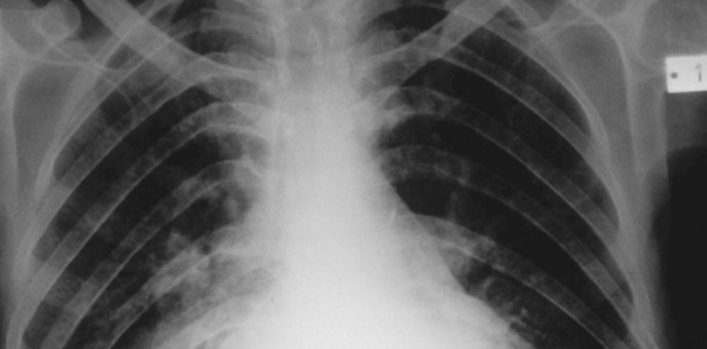 στένωσηµιτροειδούςβαλβίδος ηπίεσηεντός του αριστερού κόλπου αυξάνει προοδευτικά καιότανξεπεράσειτα 25mmHg οδηγείσε: φλεβική πνευµονική υπέρταση (στάση