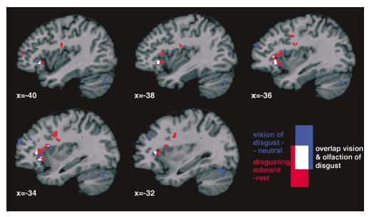 Evidence about involvement of the insula in empathy In both conditions disgust evoked activation of limbic structures such as the amygdala, cingulate cortex and anterior insula.