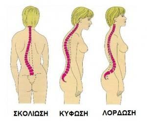 Η λόρδωση: είναι η υπέρμετρη ανάπτυξη του οσφυϊκού κυρτώματος.