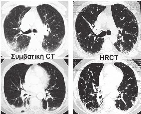 Εικόνα 3. Διαφορετική απεικονιστική και διαγνωστική προσέγγιση των υποϋπεζωκοτικών διαταραχών μεταξύ της συμβατικής και της CT υψηλής ευκρίνειας (HRCT).