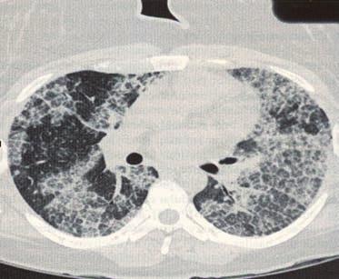 Εικόνα 6. Υψηλής ευκρίνειας CT-θώρακος που δεικνύει πάχυνση των μεσολόβιων διαφραγμάτων και πλήρωση κατά τόπους των κυψελίδων, εικόνα που περιγράφεται ως «ακανόνιστο λιθόστρωτο» (crazy paving). Γ.