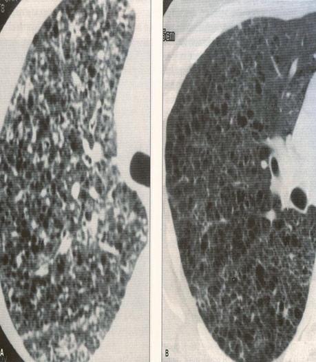 Εικόνα 8. Πολλαπλές ενδοπαρεγχυματικές κύστεις με συνύπαρξη κοιλοποιούμενων οζιδίων στην HRCT-θώρακος. Εικόνα συμβατή με τη διάγνωση του ηωσινόφιλου κοκκιώματος.