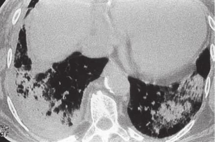 Εικόνα 9. Χαρακτηριστικό ακτινολογικό πρότυπο διαχύτων κυψελιδικών διηθημάτων άμφω. Στη δεξιά βάση οι βλάβες συρρέουν με πλήρη κατάληψη του πνεύμονα.