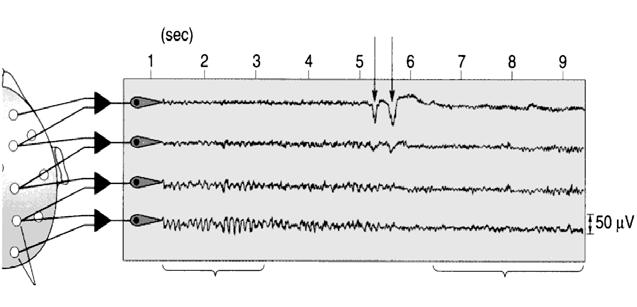 Το ύψος του ρυθµού α ποικίλει από 5-100µV (συνήθως 50 µv). Καταγράφεται κατά την εγρήγορση, όταν ο εξεταζόµενος έχει τα µάτια κλειστά.