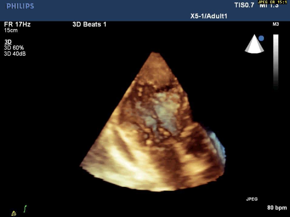 Ηχωκαρδιογράφημα 3CV-live 3D απεικόνιση- Λόγω της εκσεσημασμένης