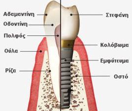 2). Εικόνα 6.1 & 6.2: Τοποθέτηση Μεταλλικού Οδοντικού Εμφυτεύματος Πηγή Είκονας 6.1: Dent Artistry Contemporary Prosthodontics Πηγή Είκονας 6.2: DontiaStoma.