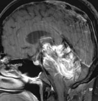 . a. b. c. (Ref: Radiographics, march 2010, vol 30, no 2483-501. Radiologic assesment of brain arteriovenous malformations: what clinicians need to know. ) ΕΙΚΟΝΑ 15.