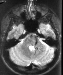 22. 23. Εικόνα 22: ΜRI T2-εικόνα δείχνει μια αστεροειδή βλάβη με φαινόμενο κενού ροής στο αρ παρεγκεφαλιδικό ημισφαίριο.