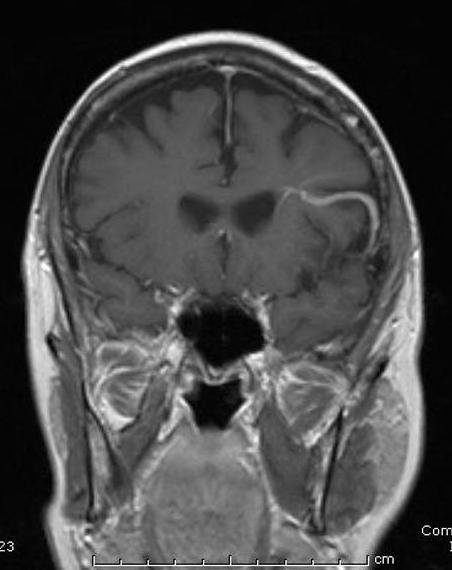 b) (πάνω δεξιά): MRI της ίδιας ασθενούς σε μεγένθυνση-το λοξό βέλος δείχνει το μοτίβο φλεβικής παροχέτευσης προς τις