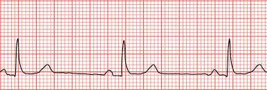 Σφυγµός Συχνότητα Ταχύς κανονικός σφυγµός : κολπική ταχυκαρδία, παροξυσµική κολπική ταχυκαρδία κολπική ταχυκαρδία µε σταθερό block.
