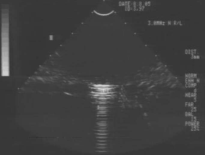 V obrázku 16.1 je gulička zreteľnejšia ako v obrázku 15.1, avšak odčítaný priemer (3,8mm) je v porovnaní so skutočným (3,97mm) o čosi horší.