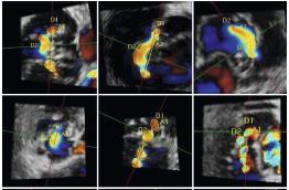 3D VENA CONTRACTA Accurate assessment of the size, shape and number of ROAs Increased accuracy of the estimation of MR flow volume