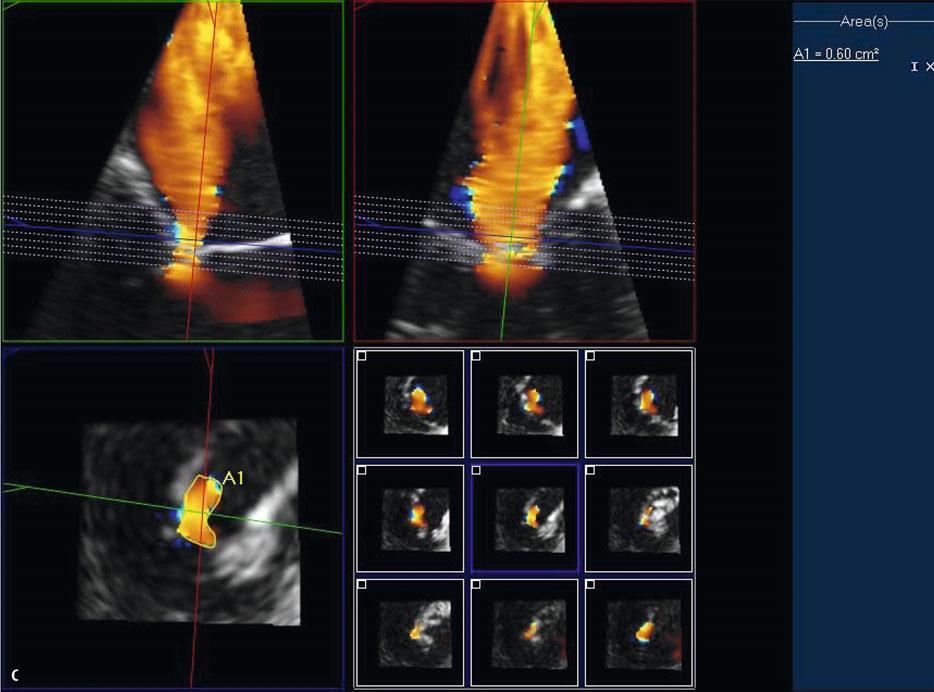 mm 2-60mm 2 -Kahlert P, et al. J Am Soc Echocardiogr. 2008;21:912 21. -Thavendiranathan P, et al. J A C C 2012;60:1470 83 -Zeng X, et al.