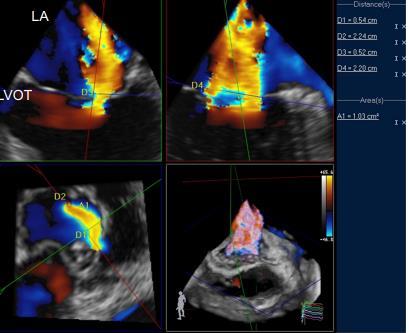 LIMITATIONS Complex dynamic changes of VCA size and shape Limited temporal and spatial resolution of 3D color Doppler datasets Artifacts PISA formula too complex Significantly different Cut-off