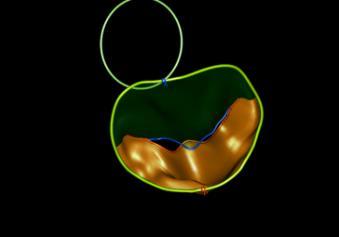 MVQ Analysis IN PRIMARY MR A dynamic view of the valve similar to that seen