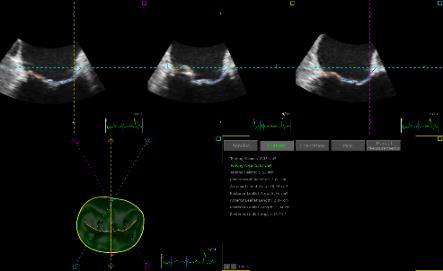 MITRAL