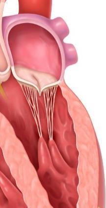 perforation, cleft, endocarditis) O Gara