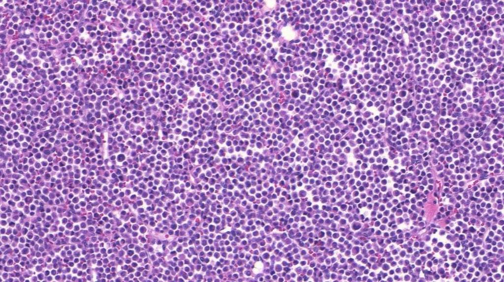 Εικόνα 28. Συμπαγής (solid) υπότυπος λοβιακού in situ καρκίνου μαστού. http://www.pacificbreastpathology.