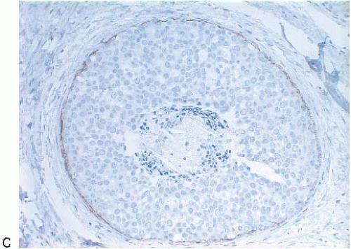 com/lobular-carcinoma-in-situ-and-atypical-lobularhyperplasia/ Εικόνα 30.