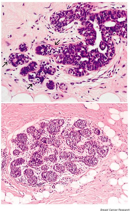 Εικόνα 34. ALH (πάνω) σε σύγκριση με LCIS (κάτω).