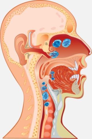 Pathogenesis of