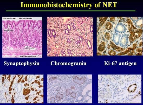 Τα νευροενδοκρινή κύτταρα εκφράζουν ειδικά μόρια όπως : Χρωμογρανίνη(CgA) Συναπτοφυσίνη(Syn) η