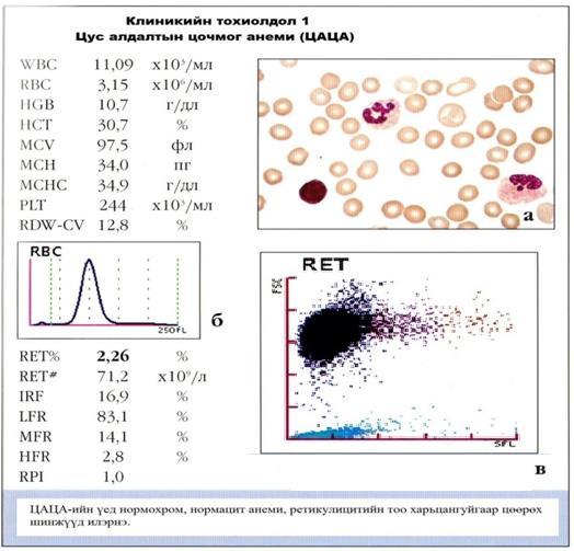 Лекц, тойм лейко/эритро Эхний хоёр хоногт цусанд эритропоэтины агууламж нэмэгдэж байгаагийн баталгаа нь эргэлтэнд полихроматофил макроцитууд илрэх бөгөөд энэ нь ретикулоцитын тоог нэмэгдүүлнэ.