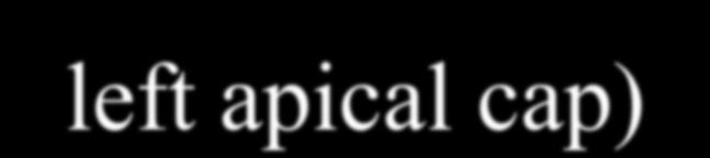 καθετήρα Κάλυμμα αριστερής κορυφής (left apical cap) Κατάσπαση αριστερού