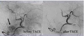 Transcatheter arterial chemoembolization(tace) καθετηριασμός τροφοφόρου