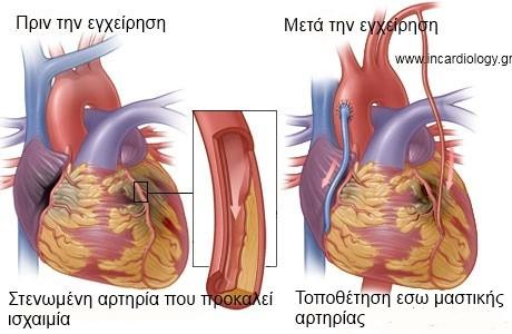 BYPASS Το Bypass ή αορτοστεφανιαία παράκαμψη είναι μια από τις συνηθείς επεμβάσεις καρδιάς. Οι στεφανιαίες αρτηρίες περιβάλλουν τον καρδιακό μυ και τον τροφοδοτούν με αίμα και οξυγόνο.