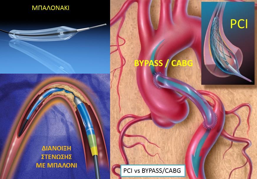 επέμβαση που αποσκοπεί στη διάνοιξη των στενωμένων ή αποφραγμένων στεφανιαίων αρτηριών. Γίνεται με την ίδια τεχνική όπως και η στεφανιογραφία.