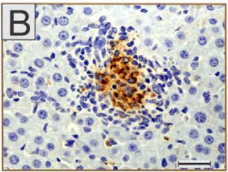 Παθογένεια Κοκκιώματα (μολυσμένα μακροφάγα, ενεργοποιημένα CD4+, CD8+ λεμφοκύτταρα, επιθηλιοειδή και γιγαντοειδή κύτταρα, ινώδης