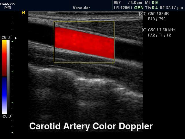 Βήμα 3 ο μελέτη με Color Doppler