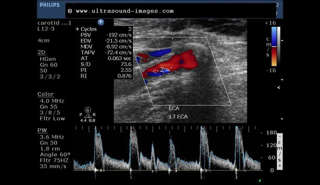 PSVcca=101cm/sec