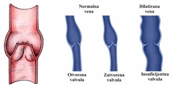 Венски залисци- валвуле су јако битан део венског система који омогућава проток венске крви у једном смеру, према срцу. Валвуле се састоје од два листића.