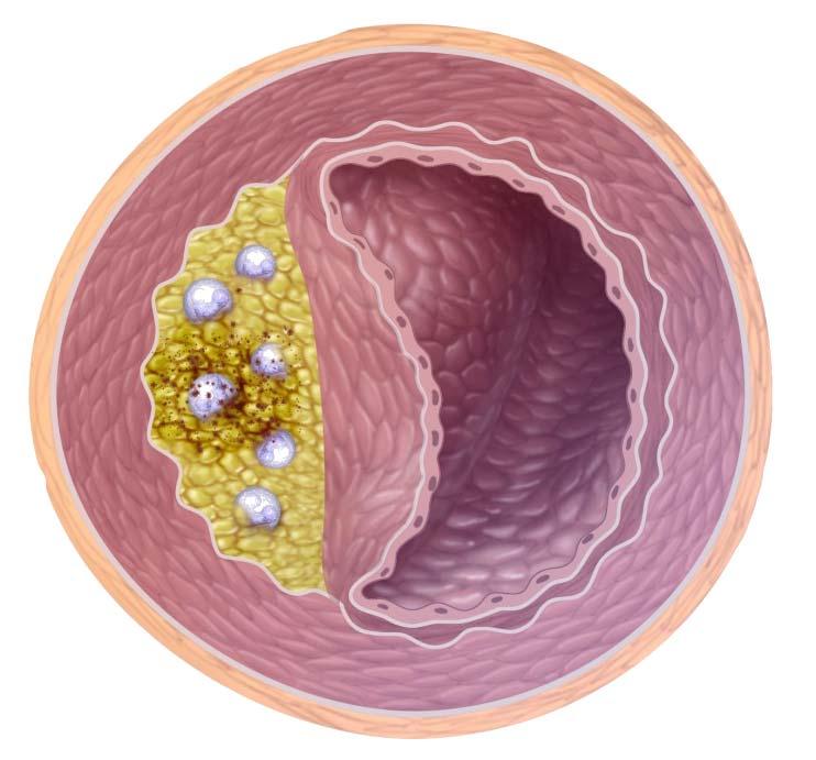 collagen content Modes t lipid pool Few inflammatory cells Ruptured Plaque High Lp-PLA 2 content (dark staining) May have minimal