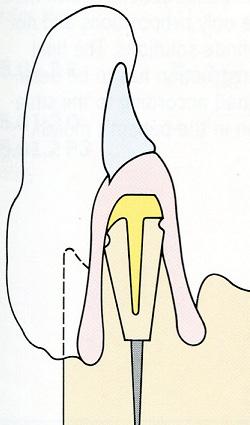 Εικόνα 10.5 Κέρινο ομοίωμα επένθετης οδοντοστοιχίας επάνω στο τελικό εκμαγείο εργασίας.