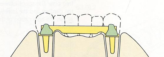 Η βασική πλάκα μαζί με τα τεχνητά δόντια αφαιρείται από το εκμαγείο. Γίνεται εφαρμογή της δοκού επάνω στις χυτές καλύπτρες με τη χρήση του ειδικού μαντρέλ και του παραλληλιστή. Εικόνα 10.